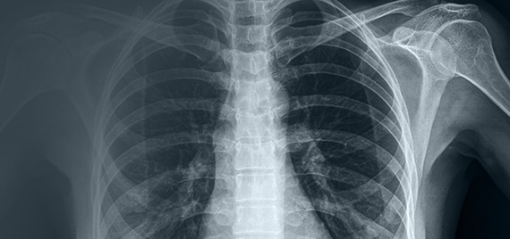 When and Where Does Mesothelioma Spread?