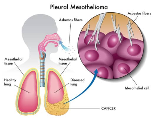 Be Proactive and Seek Mesothelioma Legal Advice