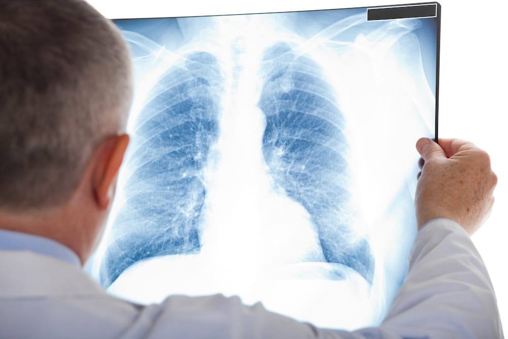 Mesothelioma Awareness: 4 Important Points to Understand